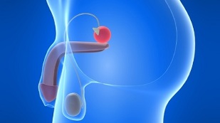 prostatos masažas prostatito profilaktikai
