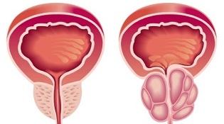 prostatito ir prostatos adenomos išsivystymo priežastys